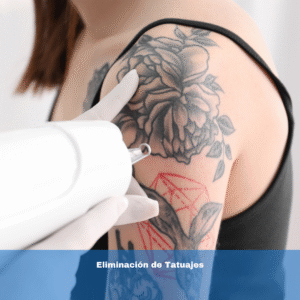 Eliminación de Tatuajes
