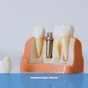 Implantología Dental